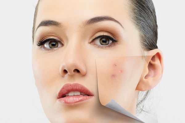 Acne How To Remove Pimple : ये घरेलू उपाय एक दिन में भगा देंगे आपको पिम्पल